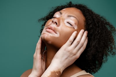 Vitiligo.