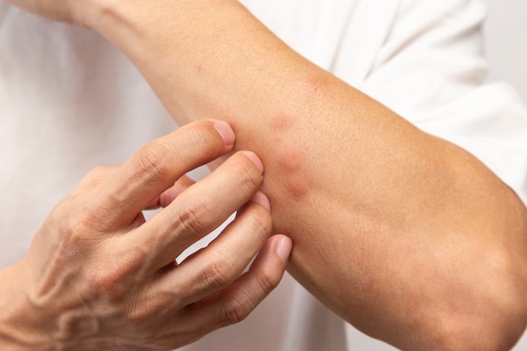 Concepto de picaduras de mosquitos.