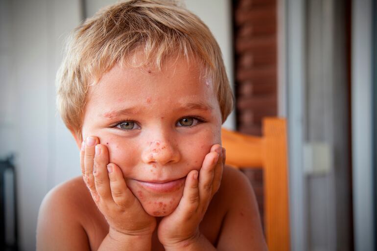 La enfermedad puede durar de 7 a 10 días. 