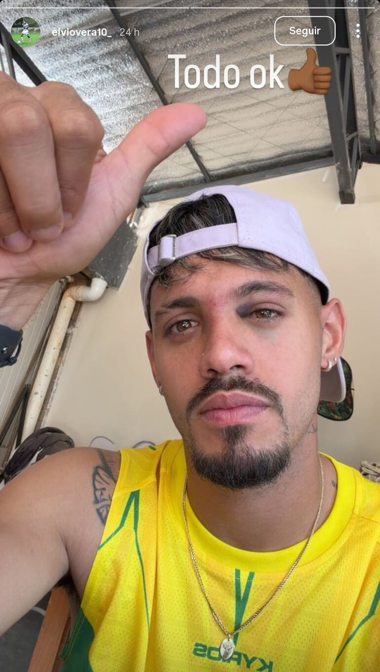 Así quedó el delantero del Sportivo Ameliano, Elvio Vera, tras el impacto que le propinó el lateral de Olimpia César Olmedo.