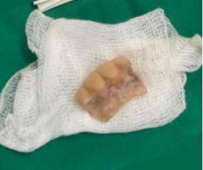 Extraen prótesis dentaria de la laringe de un hombre de 35 años.