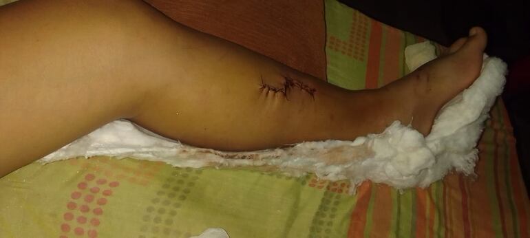 Pierna lesionada de la pasajera del moto Bolt.  (gentileza).