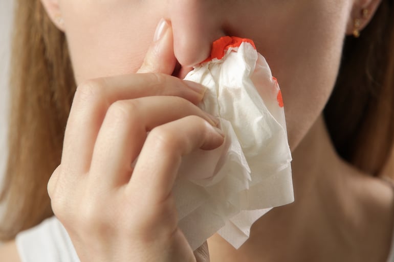 Sangrado nasal, imagen ilustrativa.