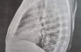 Radiografía de un brazo, sin personas visibles, mostrando huesos y estructuras internas detalladas en un ambiente clínico.