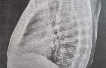Radiografía de un brazo, sin personas visibles, mostrando huesos y estructuras internas detalladas en un ambiente clínico.