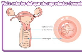actualmente-existen-vacunas-disponibles-contra-algunas-variedades-mas-agresivas-del-vph-como-las-que-causan-el-cancer-de-cuello-uterino-y-se-aplica-a-220556000000-1382223.jpg