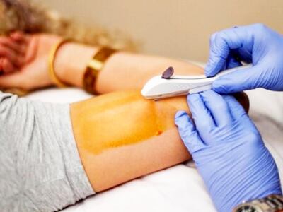 El dispositivo subdérmico anticonceptivo se coloca mediante un procedimiento simple y su efecto dura tres años, afirman.