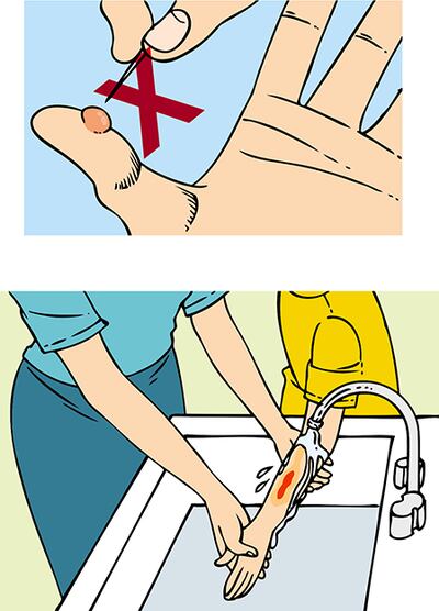 Primeros auxilios: quemaduras