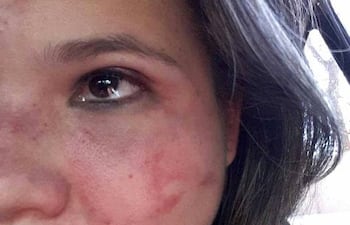 mujer-brutalmente-golpeada-vuelve-con-su-pareja-tras-perdonar-todo-225911000000-1648350.jpg