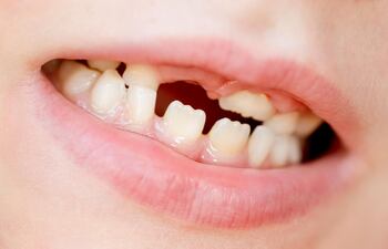 la-mayoria-de-los-ninos-vive-la-perdida-de-dientes-con-orgullo-y-alegria--10446000000-1770427.jpeg