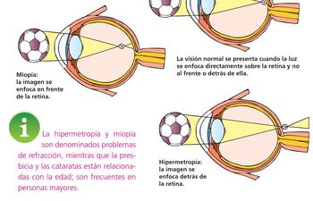 la-hipermetropia-y-miopia-son-denominados-problemas-de-refraccion-mientras-que-la-presbicia-y-las-cataratas-estan-relacionadas-con-la-edad-son-frecu-223753000000-1376972.jpg