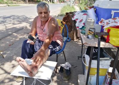 Sánchez muestra su pierna izquierda, que está deformada. Ahora usa bastón y vende minutas en una esquina del B° Las Colinas.