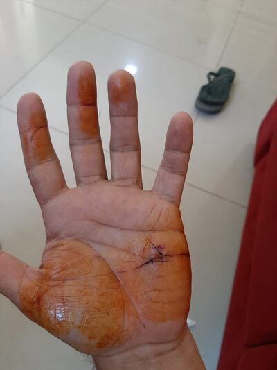 El hombre tuvo heridas defensivas en la mano y el muslo.