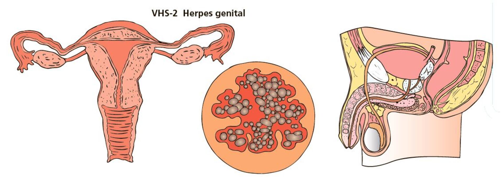 herpes genital simple tipo 2