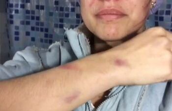 la-joven-estudiante-de-teatro-dana-boveda-valdivieso-muestra-los-hematomas-en-el-antebrazo-rostro-y-otras-partes-del-cuerpo-resultado-de-una-tecn-200914000000-1480221.jpg