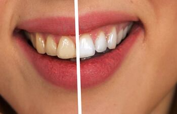 blanqueamiento-dental-191057000000-1797864.jpg