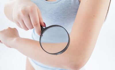 Los lunares son de tipos muy variados y tienen nombres muy distintos. Siempre es bueno que los revise un especialista.