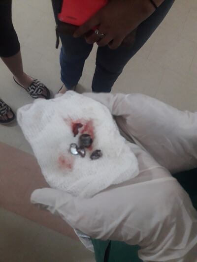 Fragmentos de la bala extraídos del torax del policía. El mismo se encuentra con vida pero en estado de observación.