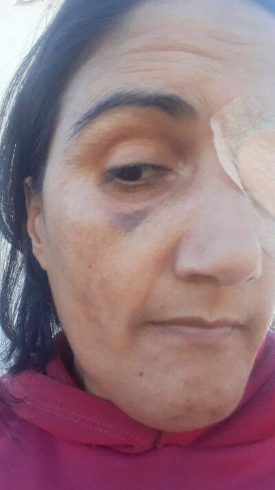 María Cripina Coronel con discapacidad visual muestra los hematomas tras la golpiza y denunció discriminación y maltrato en el juzgado de paz de J. Augusto Saldivar.