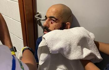 Danilo Fernandes sufrió daños muy cerca del ojo a causa de la bomba que explotó en el interior del bus de Bahía.