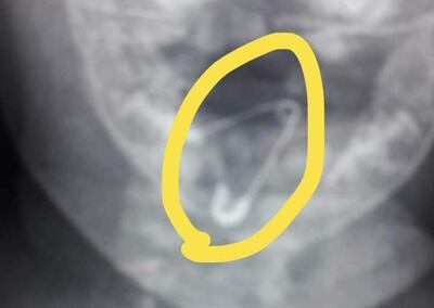 El prendedor abierto alojado en la garganta de la beba.