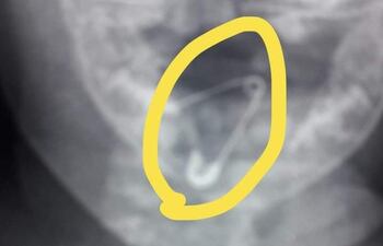 El prendedor abierto alojado en la garganta de la beba.