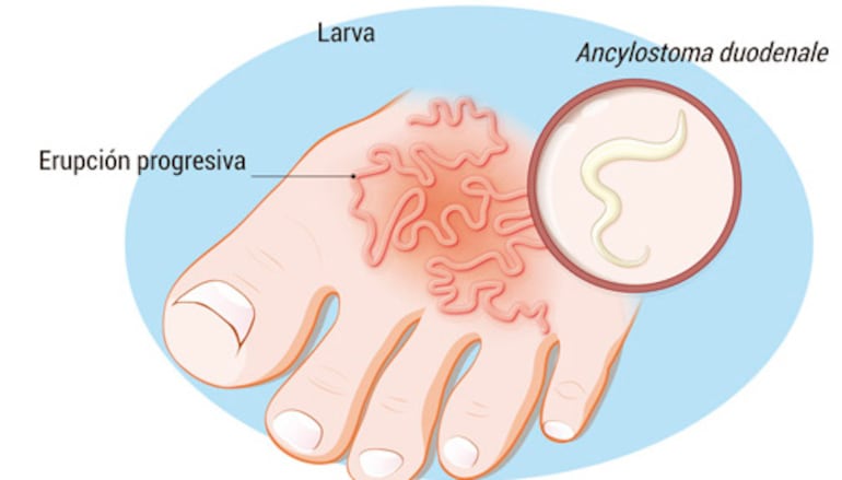Anquilostomiasis y ascariasis