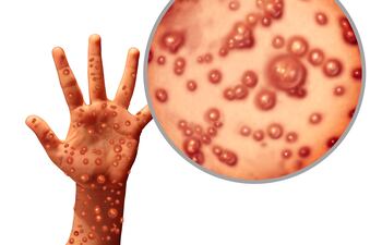 La viruela del mono tiene síntomas bien identificados, pero hay otros que no aparecen reconocidos en las definiciones médicas de esta enfermedad, como las lesiones genitales o las llagas en la boca, por lo que conocerlos ayudará a un mejor diagnóstico.