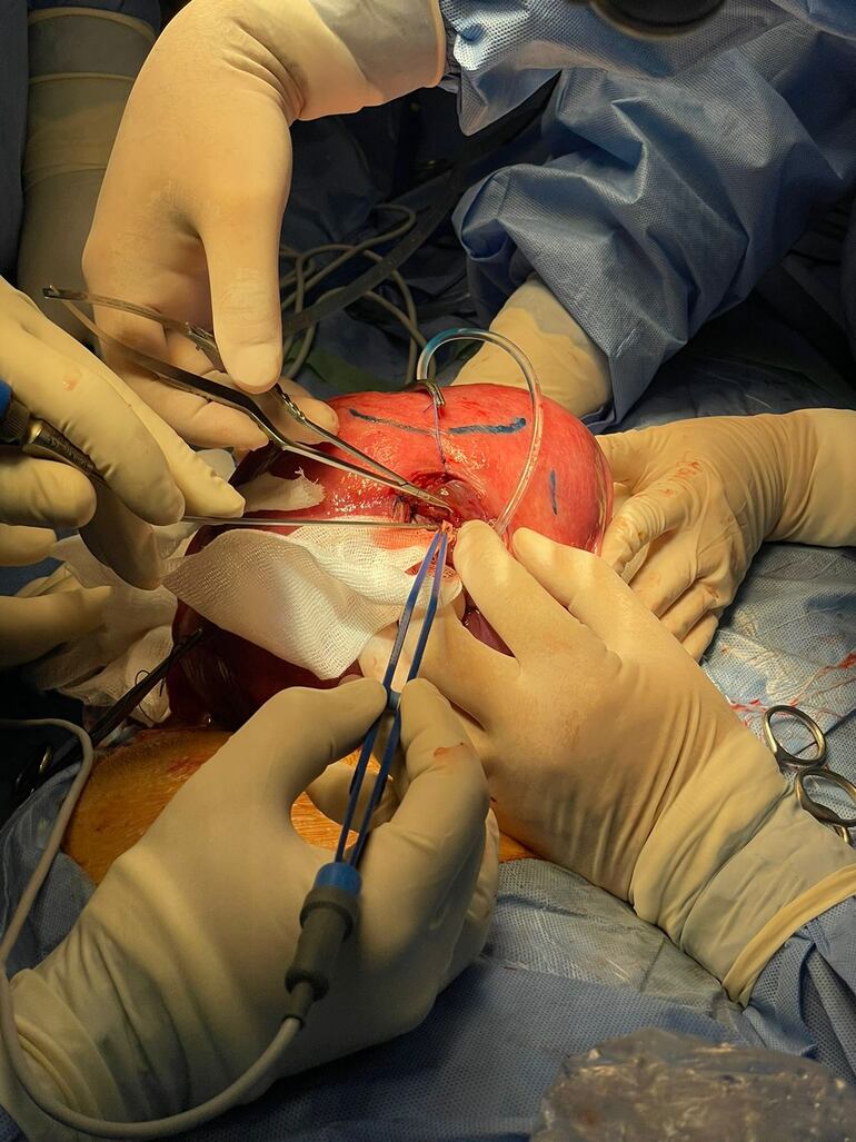 El feto es monitorizado por el equipo de perinatología encabezado por el Dr. Orlando Alfonso, que ve dónde está la placenta que no se debe tocar. Evalúa si tiene buenos latidos, la cantidad de líquido, según relató la especialista.