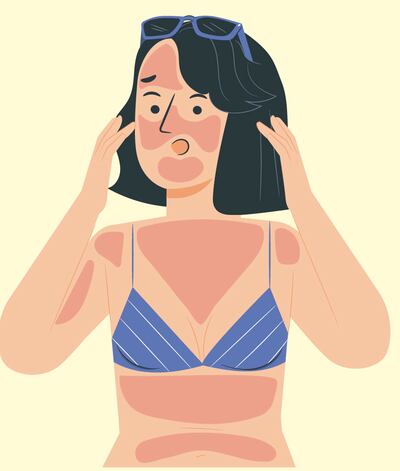 Quemaduras solares: cómo evitar