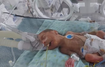 Evann Alejando, nació pesando apenas 941 gramos y lleva dos meses hospitalizado en el Hospital de Clínicas.