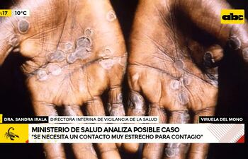 El primer caso sospechoso de viruela del mono se trata de una mujer de 34 años del departamento Central.