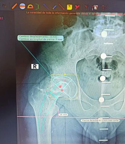 Radiografía la primera cirugía de prótesis de cadera realizada en el Hospital de Clínicas.