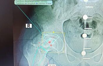 Radiografía la primera cirugía de prótesis de cadera realizada en el Hospital de Clínicas.