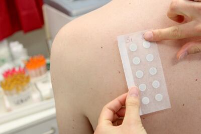 Los pediatras recurren a las pruebas con parches para encontrar la pista de los agentes que causan alergias en niños.
