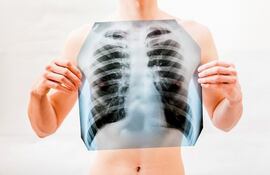 Imagen de referencia. Investigadores del Cima Universidad de Navarra han logrado que los tumores de pulmón resistentes a la inmunoterapia respondan al tratamiento, al descubrir que su ‘talón de Aquiles’ está en la inhibición de DSTYK.