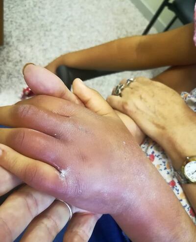 Así estaba la mano de la niña de 9 años, a causa de una fractura infectada.