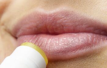 Los comúnmente llamados “fuegos” o llagas en la boca, en realidad son ulceraciones de la mucosa en la cavidad oral y pueden tener diferentes etiologías.