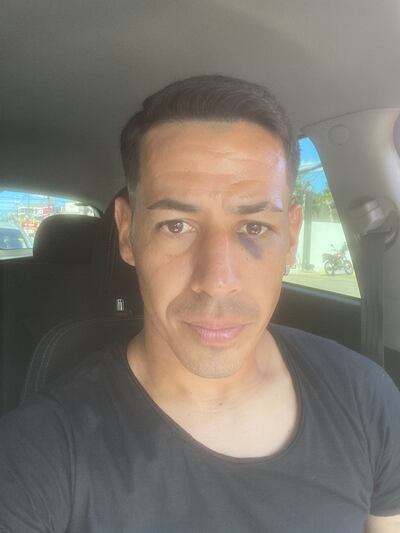 Así quedó el rostro del volante Édgar Zaracho, luego de recibir el codazo del delantero Tricolor, Gustavo Aguilar.