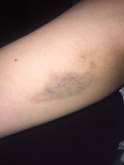 Uno de los tantos golpes que presenta la mujer en su cuerpo, según las evidencias.