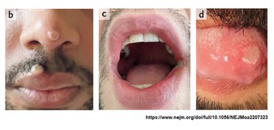 Las autoridades suizas aún no dan luz verde a la vacunación contra la viruela del mono, contrariamente a lo que están haciendo varios países europeos, lamentó hoy la especialista en enfermedades infecciosas y responsable de la unidad de sida en el Hospital Cantonal de Ginebra, Alexandra Calmy.