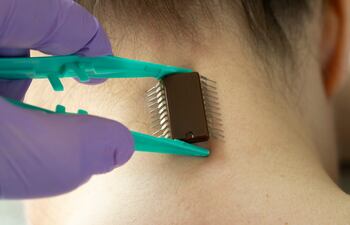 chip microchip humano Implantation,Of,Chip,Under,The,Human,Skin.,Microchip,Is,Connected