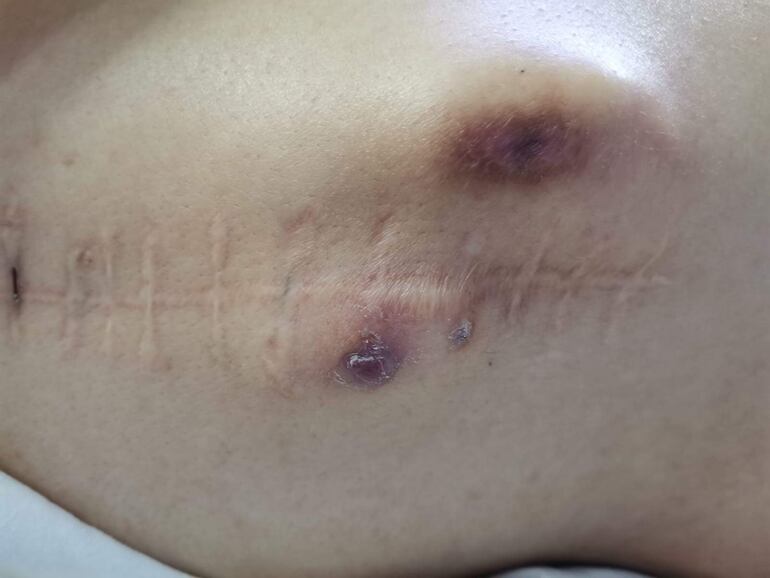 Imagen de la columna de la joven Sofía Espínola que aguarda la solidaridad de la ciudadanía para someterse a otra cirugía de su columna vertebral y mejorar su calidad de vida.