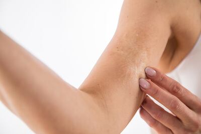 Los seguros de salud cubren a veces los costos del tratamiento de cicatrices, como cuando la cicatriz impide estirar el brazo.