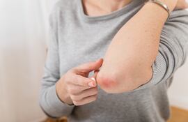 Los enfermos de psoriasis no solo deben cuidar su piel, sino también su psiquis.