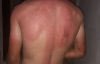 La espalda de menor con serias heridas tras el brutal castigo recibido por parte de su tío.