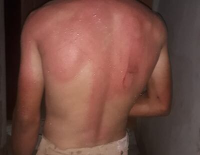 La espalda de menor con serias heridas tras el brutal castigo recibido por parte de su tío.