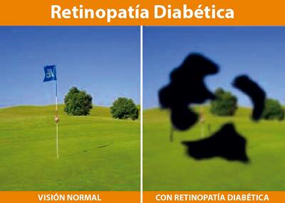 Lo que causa la retinopatía diabética, según profesionales de la salud.