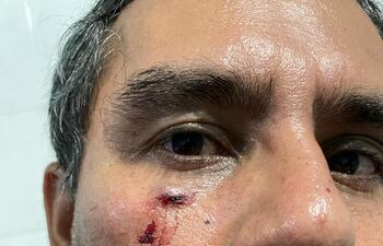 Marcos Andino muestra rastros de la agresión que sufrió anoche supuestamente por un grupo de liberales.