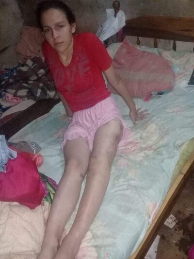 Joven pide ayuda se encuentra postrada en Ybycuí.